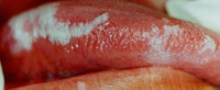 leucoplasia vellosa