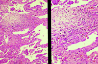 dr reckewegfor intersticial cystitis